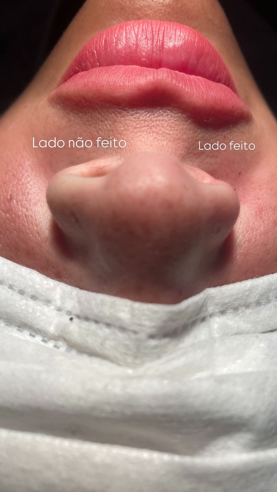 Caso 2 de alectomia com diminuição das asas nasais antes e depois