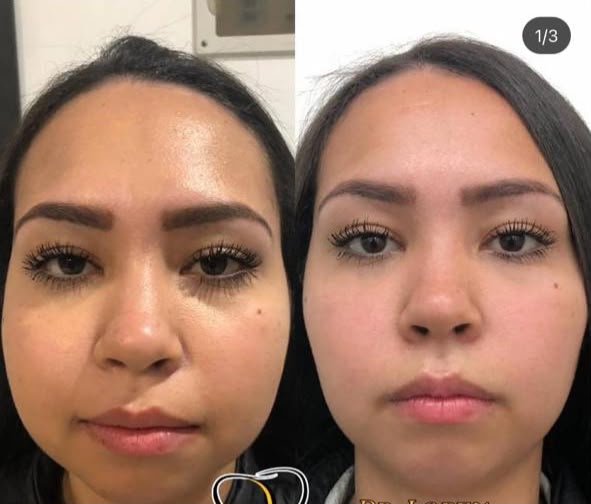 Caso 1 de bichectomia com bioplastia facial antes e depois