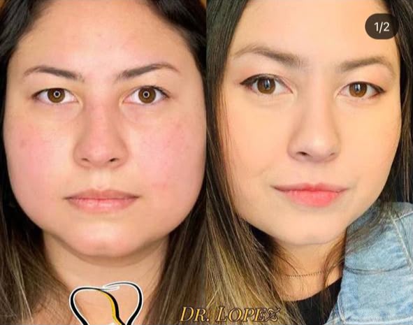 Caso 2 de bichectomia com bioplastia facial antes e depois