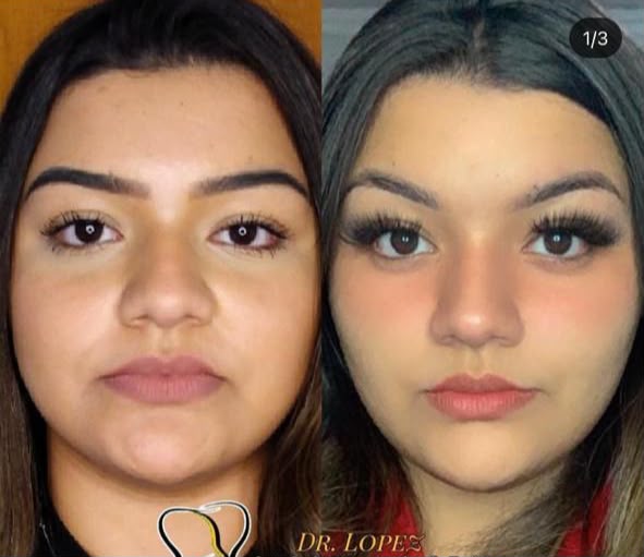 Caso 3 de bichectomia com bioplastia facial antes e depois