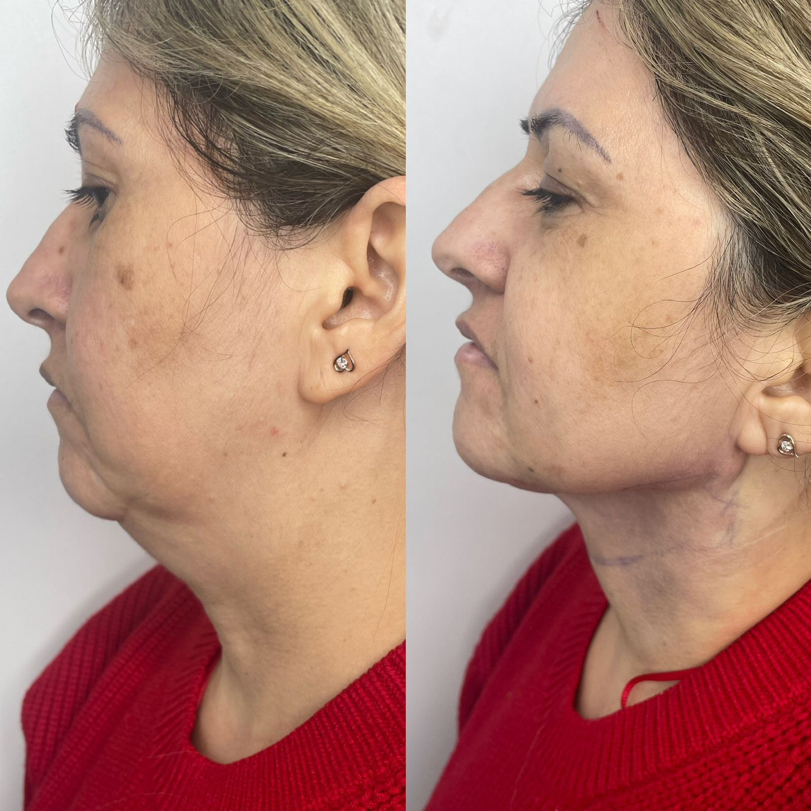 Caso 1 de lipoescultura HD de papada e pescoço com comparação de perfil antes e depois
