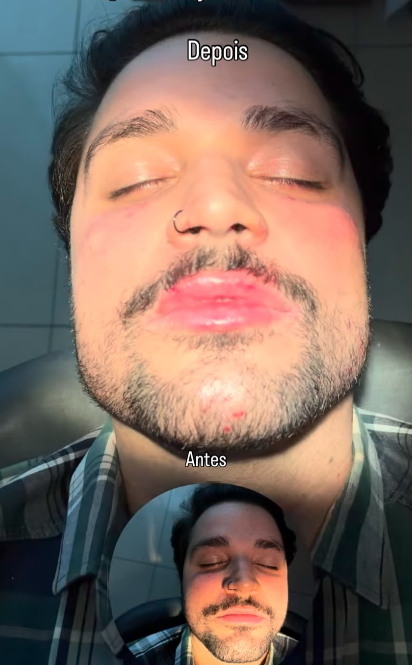 Caso 1 de harmonização orofacial masculina com comparação antes e depois