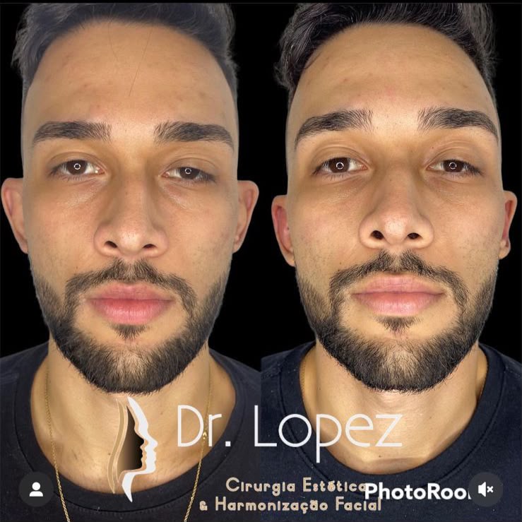 Caso 2 de harmonização orofacial masculina com comparação antes e depois