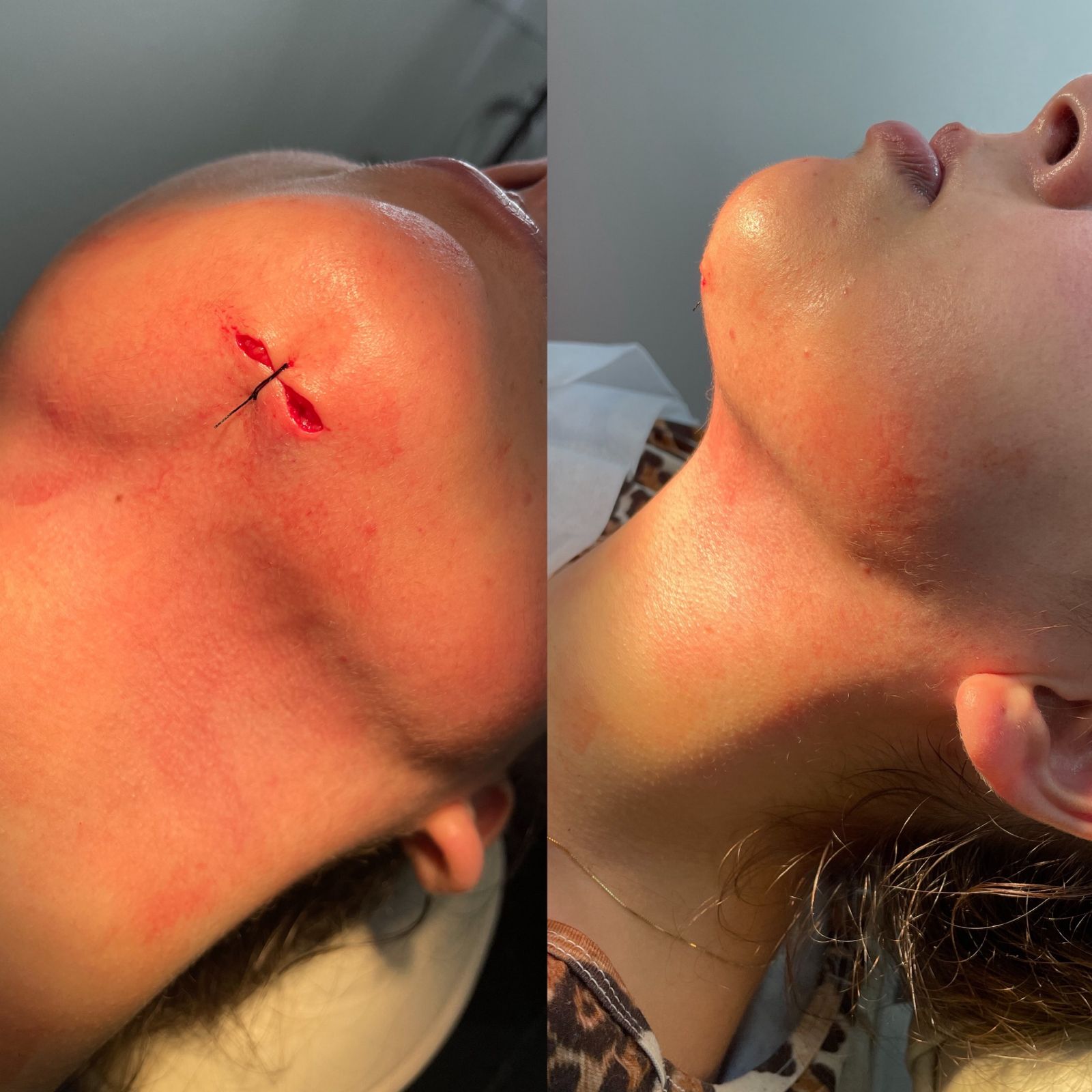 Caso 2 de lipoescultura HD de papada e pescoço com comparação antes e depois