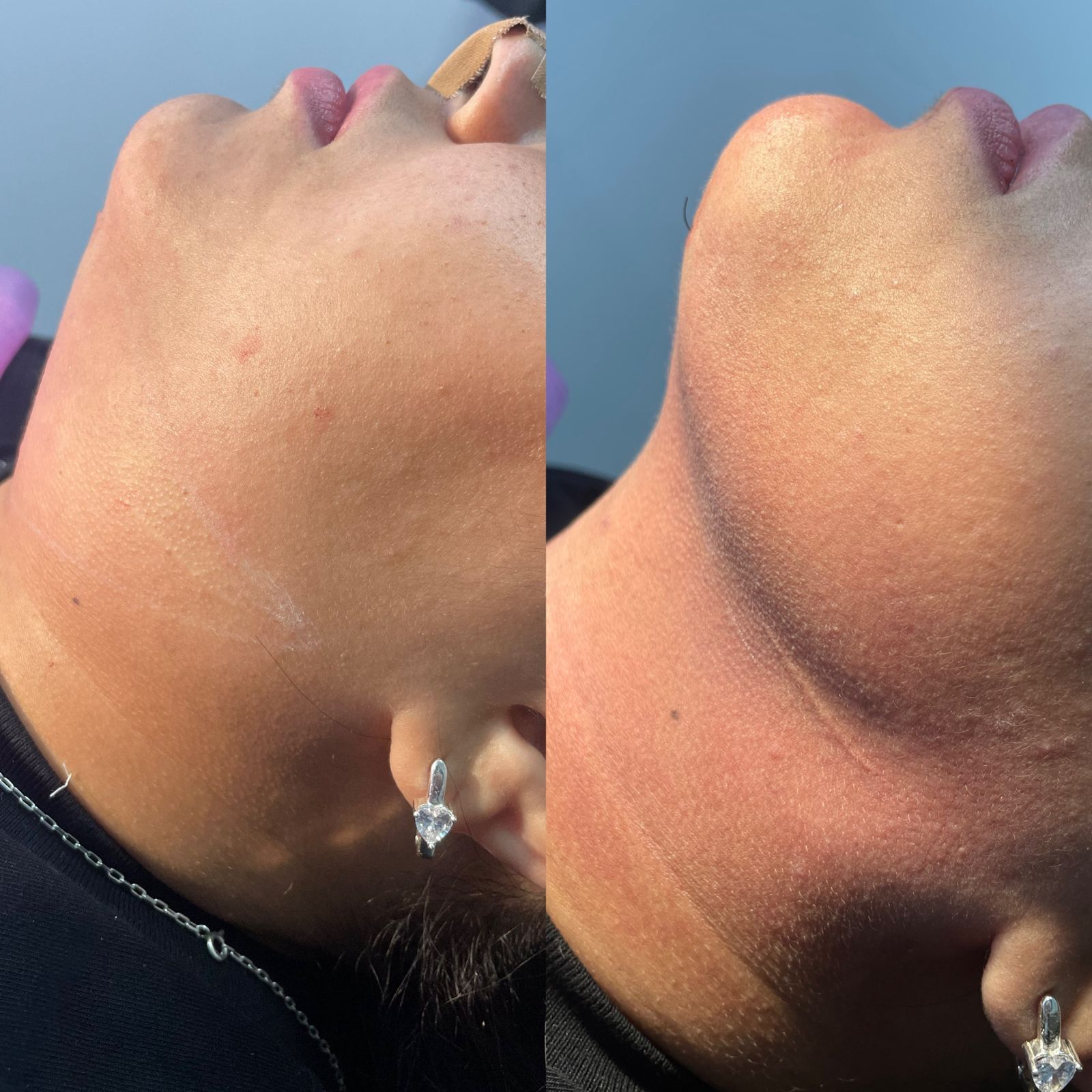 Caso 3 de lipoescultura HD de papada e pescoço com comparação antes e depois
