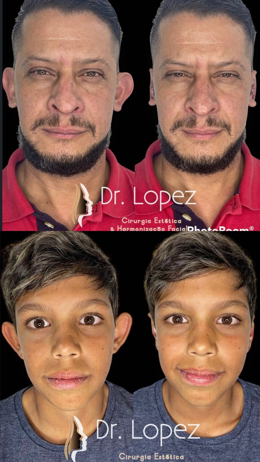 Caso 2 de otomodelação de orelha de abano com comparação antes e depois