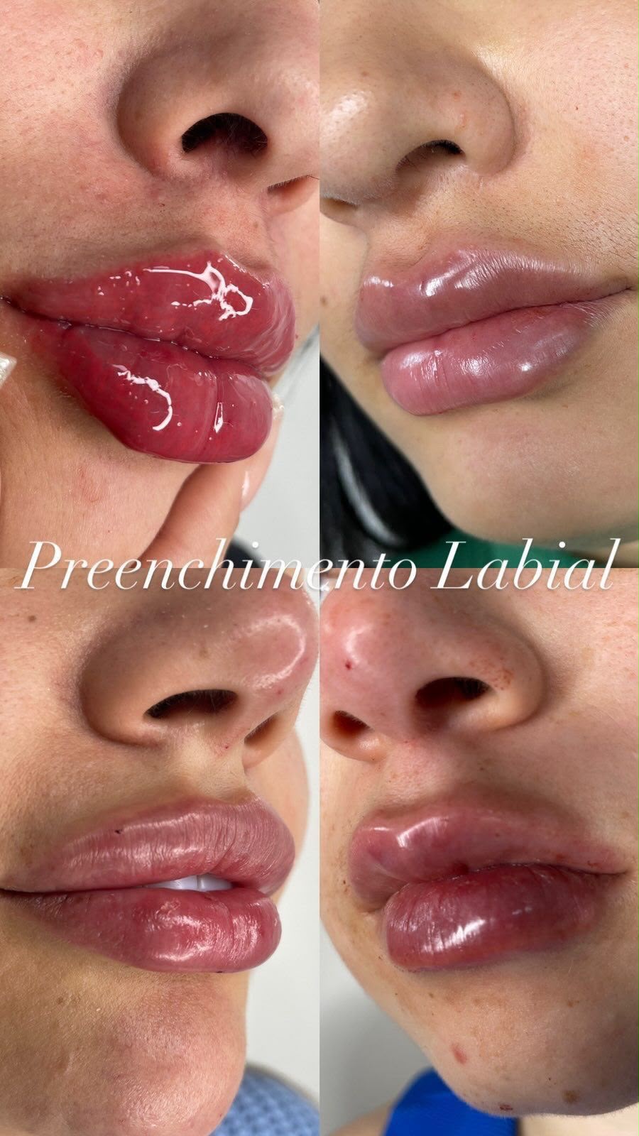 Caso 1 de preenchimento labial antes e depois