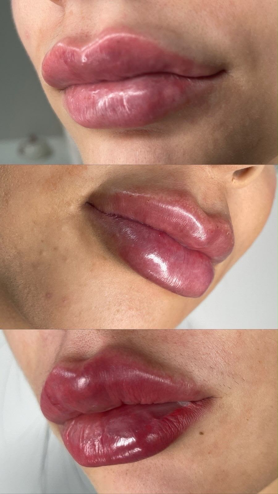 Caso 3 de preenchimento labial antes e depois