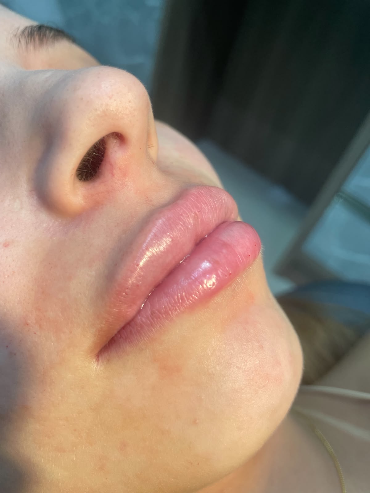 Caso 2 de preenchimento labial antes e depois